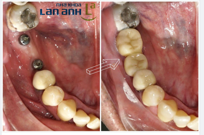 Cấy ghép Implant là giải pháp tối ưu phục hồi răng mất để đảm bảo chức năng ăn nhai và thẩm mỹ.