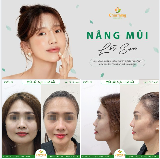NÂNG MŨI LÓT SỤN - MỘT TRONG NHỮNG PHƯƠNG PHÁP NÂNG MŨI ĐƯỢC ƯA CHUỘNG NHẤT