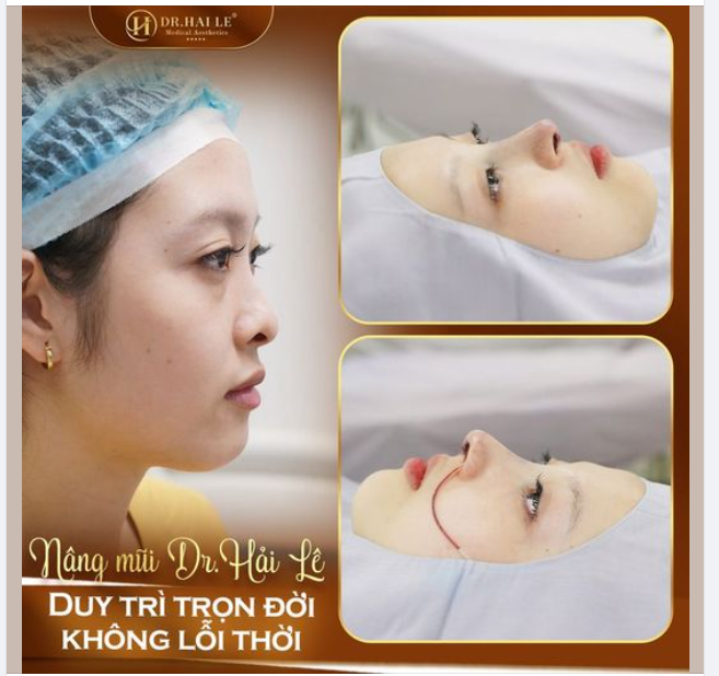 Nâng mũi Dr Hải Lê  - Duy trì trọn đời không lỗi thời