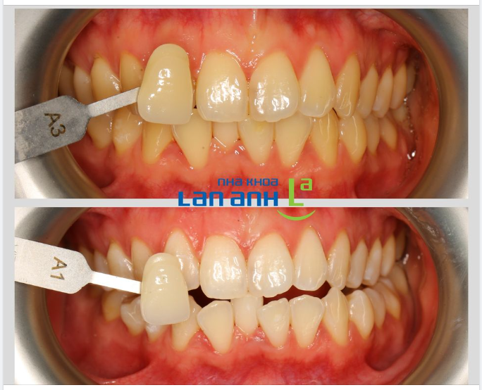 Bạn có biết, là kết quả tẩy trắng răng cho mỗi người là mỗi khác?!