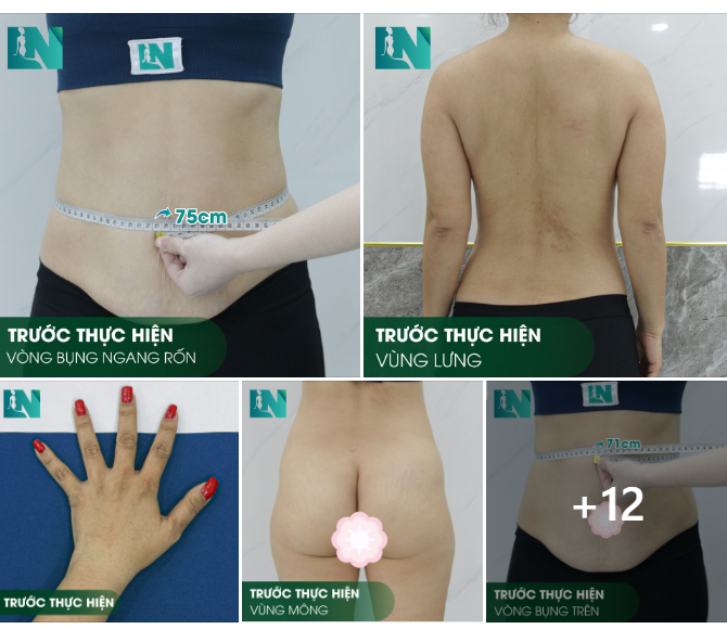HÌNH ẢNH TRƯỚC KHI THỰC HIỆN COMBO TÔN TẠO SẮC VÓC CỦA CHỊ KHÁCH SINH NĂM 1981