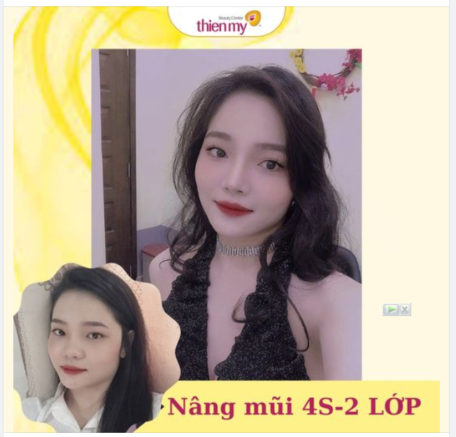 Những lưu ý nâng mũi bọc sụn 4S - 2 lớp: