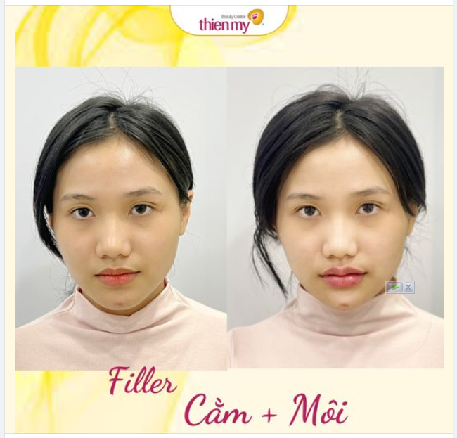 FILLER - Phương pháp làm đẹp không phẫu thuật KH đã lựa chọn: