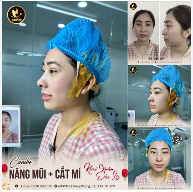 UPDATE NHAN SẮC NĂM MỚI VỚI COMBO NÂNG MŨI + CẮT MÍ MẮT