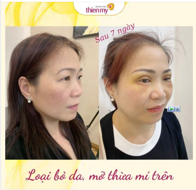 Hình ảnh khách hàng sau khi CẮT MÍ TẠI THIỆN MỸ