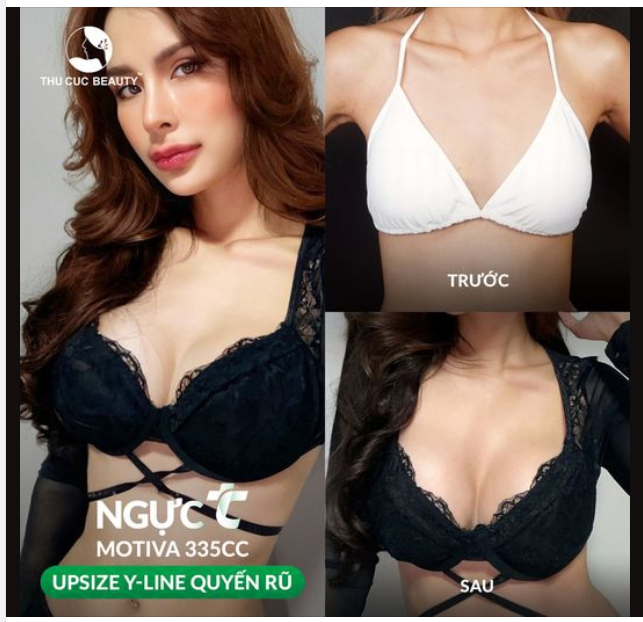 Khách hàng chọn nâng ngực size 335cc quyến rũ