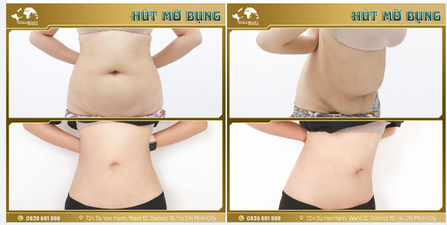 Mỡ bụng sẽ không còn là rào cản khiến bạn mất tự tin diện Tết khi đến với Thế Giới Đẹp chỉ sau 1 lần Hút mỡ.