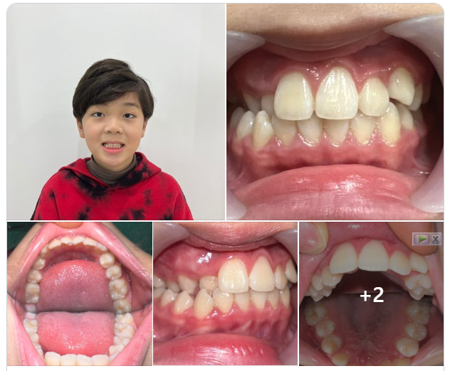 CON BẠN CÓ ĐANG GẶP PHẢI TÌNH TRẠNG NHƯ THẾ NÀY? ĐẾN GẶP BÁC SĨ NHA KHOA GIA ĐÌNH NGAY NHÉ!