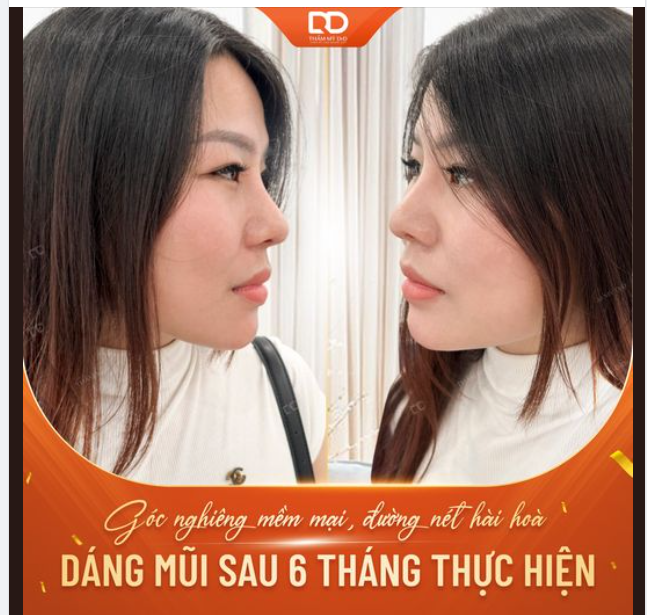 "RINH" MŨI XINH SAU 45 PHÚT THỰC HIỆN