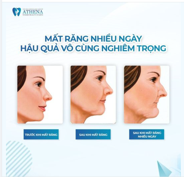 HẬU QUẢ NGHIÊM TRỌNG KHI BỊ MẤT RĂNG, BẠN ĐÃ BIẾT CHƯA?