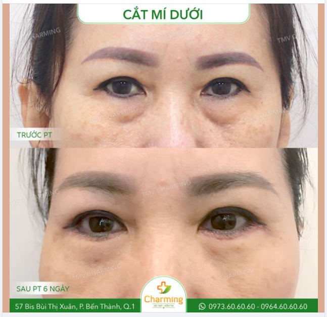Với một đôi mắt có phần bọng mỡ mí dưới nhiều thì cách tốt nhất để loại bỏ phần bọng mỡ đó chính là cắt mí dưới, và cô khách của Charming đã có một quyết định đúng đắn
