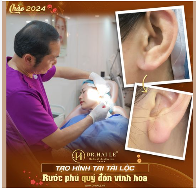 Filler tạo hình tai tài lộc -Rước phú quý đón vinh hoa