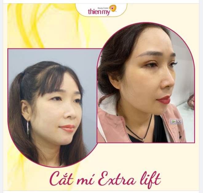 Chọn cắt mí Extra lift tại Thiện Mỹ chỉ mất 30p có ngay mí đẹp, khắc phục tình trạng sụp mí.