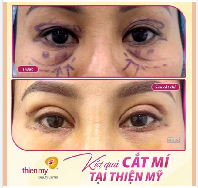 COMBO CẮT MÍ TRÊN, DƯỚI – NHÂN ĐÔI VẺ ĐẸP “CỬA SỔ TÂM HỒN”