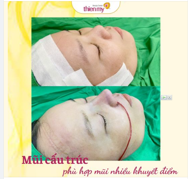 Một chiếc mũi không hài hòa với toàn thể gương mặt cũng khiến cho người phụ nữ không tự tin về nhan sắc trước mắt bạn đời.