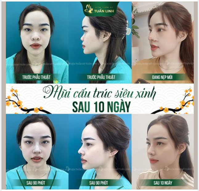 10 ngày thay đổi có ngay mũi xinh!!