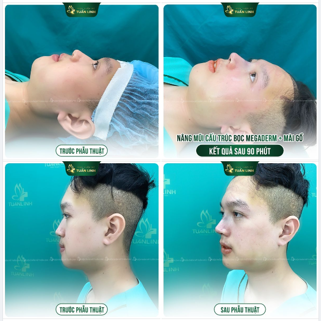 NÂNG MŨI CẤU TRÚC NAM VỪA HOÀN THÀNH SAU 90 PHÚT!