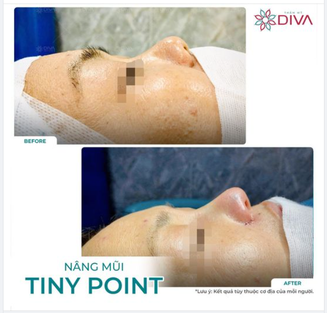 NÂNG MŨI TINY POINT: MŨI CAO TỰ NHIÊN CÂN ĐỐI