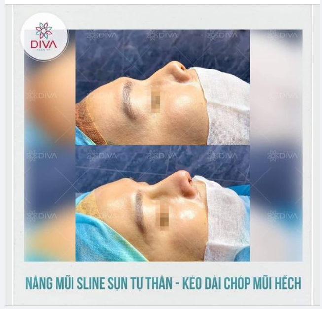 CẢI THIỆN MŨI NGẮN, HẾCH VỚI NÂNG MŨI SLINE SỤN TỰ THÂN