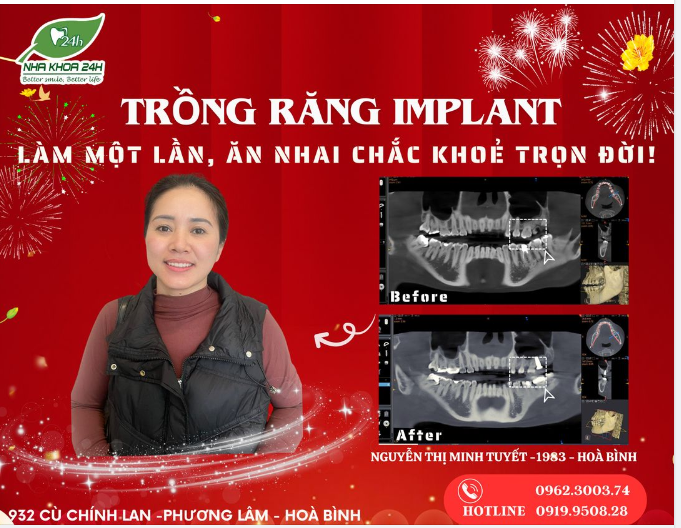 PHÁT LỘC PHÁT TÀI - KHAI XUÂN GIÁP THÌN - TRỤ IMPLANT CHỈ 10,8TR