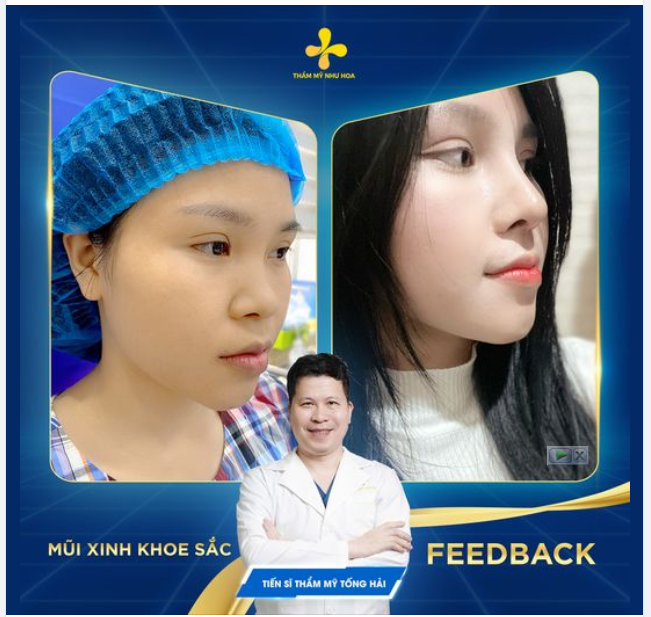 CHỈ SAU 30 NGÀY: DÁNG MŨI “ÔM FORM” ĐẸP ĐẾN KHÓ TIN