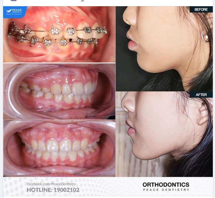 Chút động lực cho những bạn đang có ý định niềng mà còn đắn đo, kết quả chắc chắn không khiến các bạn thất vọng đâu. Chúc các bạn sớm có nụ cười xinh rạng ngời".