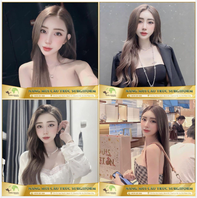 Mãn nhãn với sắc diện xinh đẹp, rạng rỡ của 9X sau 10 tháng nâng cấp mũi tại Thế Giới Đẹp!
