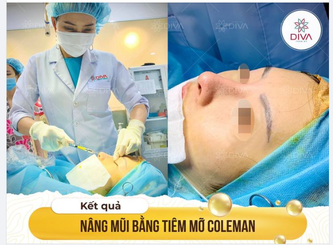KẾT QUẢ THẨM MỸ SAU CẤY MỠ COLEMAN MŨI