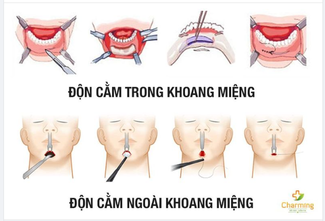 NÊN RẠCH ĐƯỜNG TRONG HAY ĐƯỜNG NGOÀI KHI ĐỘN CẰM?