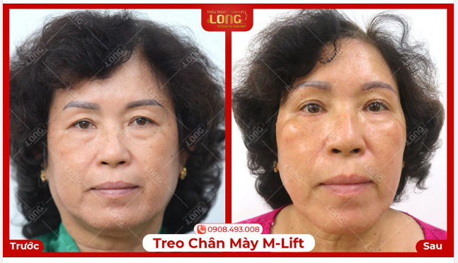 Rạng rỡ hơn và tự tin hơn sau khi treo chân mày và lấy da dư