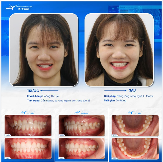 XÓA BỎ HOÀN TOÀN RĂNG MÓM, LỆCH HÀM MẶT SAU 2 NĂM NIỀNG RĂNG!
