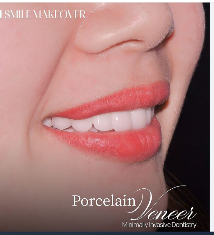 MẶT DÁN SỨ VENEER  XÂM LẤN TỐI THIỂU
