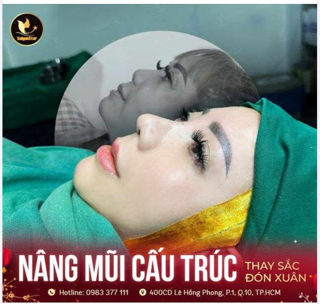 NÂNG MŨI CẤU TRÚC – THAY SẮC ĐÓN XUÂN