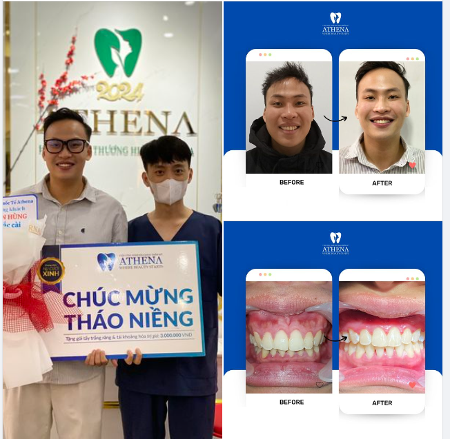 Tháo Niềng Răng Thành Công: Hành Trình Tự Tin Tới Năm 2024