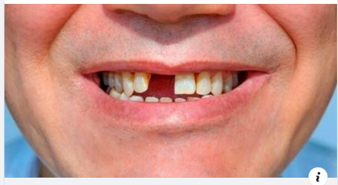 Không trồng răng giả sau khi nhổ răng có sao không?