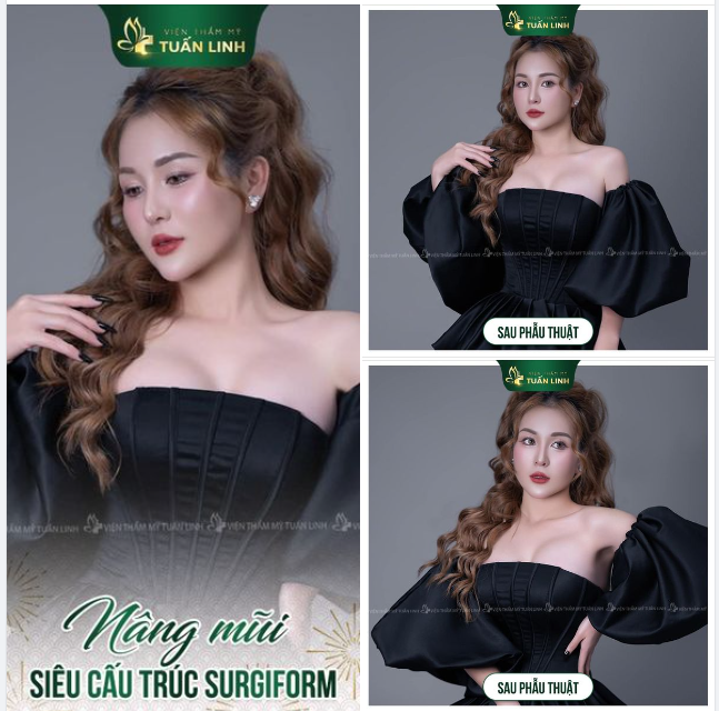NÂNG MŨI SIÊU CẤU TRÚC SURGIFORM