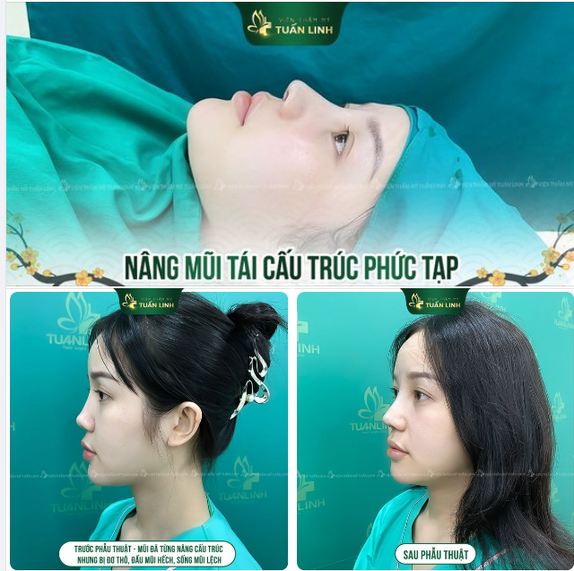 NÂNG MŨI TÁI CẤU TRÚC PHỨC TẠP