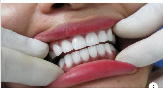 Những cảm giác sau khi bọc răng sứ thường gặp