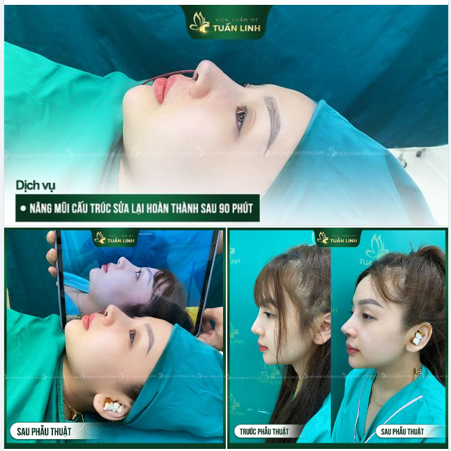 Khắc phục hoàn toàn mũi lộ sống, tuột sụn, mũi đơ thô
