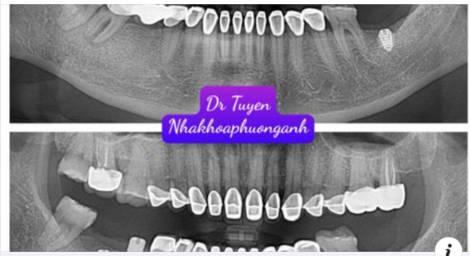 Hướng dẫn chăm sóc răng sau cấy implant
