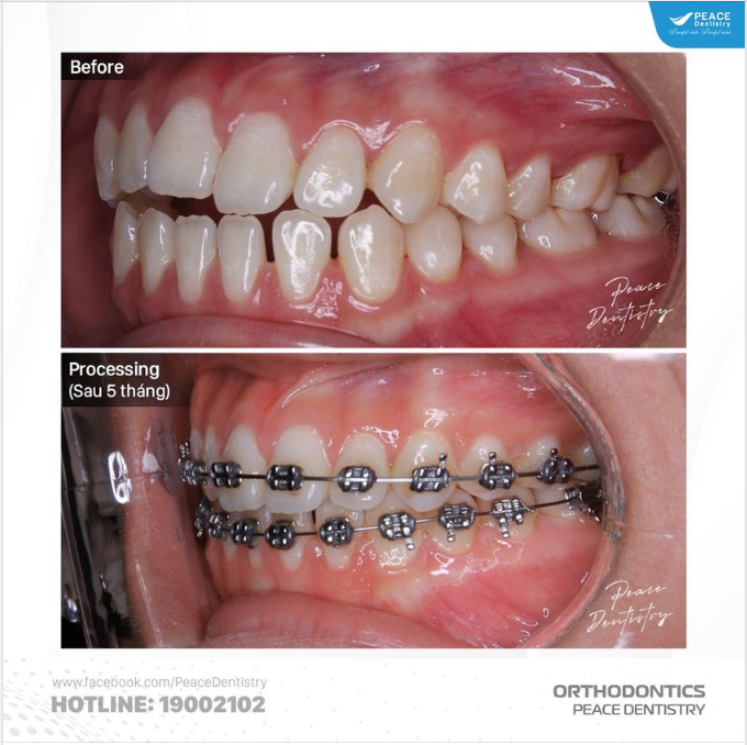 ORTHODONTICS  PROCESSING