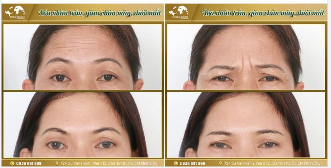 Xóa nhăn hiệu quả cùng lúc nhiều vị trí trên khuôn mặt.