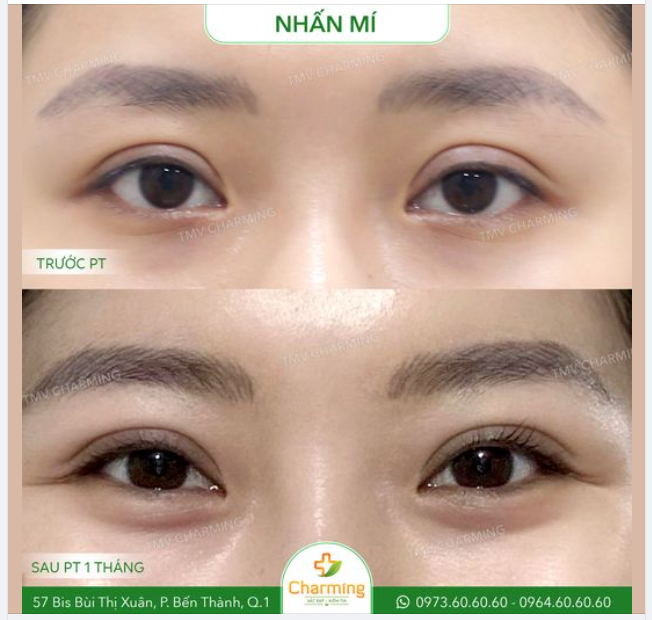 Đối với những đôi mắt có 2 mí to không đều nhau hoặc mí quá sâu, bạn có thể thực hiện nhấn mí để khắc phục tình trạng ấy.