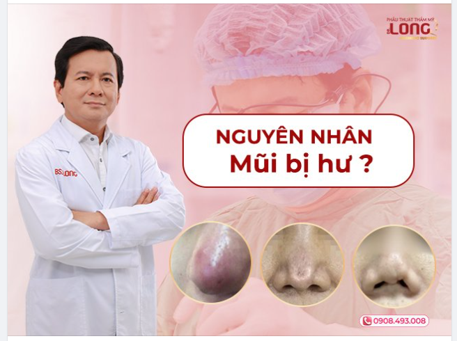 NGUYÊN NHÂN KHIẾN DÁNG MŨI BỊ HỎNG SAU NÂNG ĐÓ LÀ GÌ?