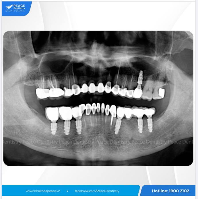 TÌM LẠI NỤ CƯỜI TUỔI XẾ CHIỀU: