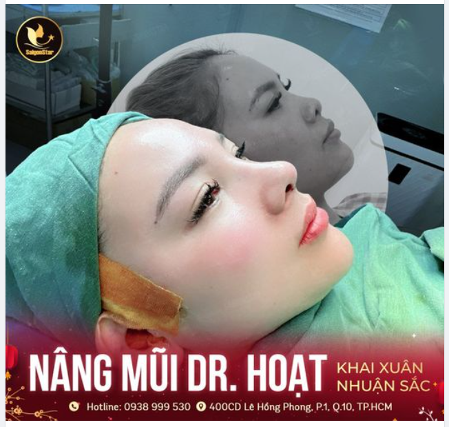 NÂNG MŨI DR. HOẠT  KHAI XUÂN NHUẬN SẮC