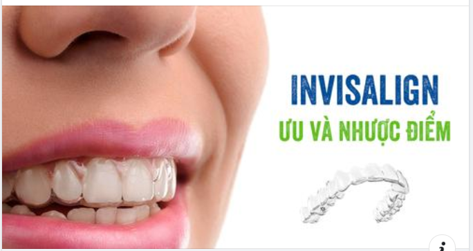 Niềng Răng Bằng Invisalign So Với Niềng Răng Truyền Thống