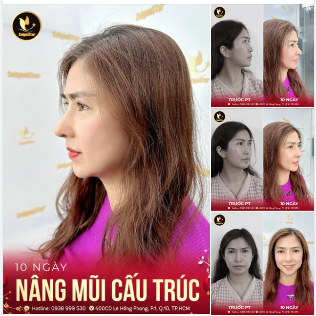 10 NGÀY NÂNG MŨI CẤU TRÚC
