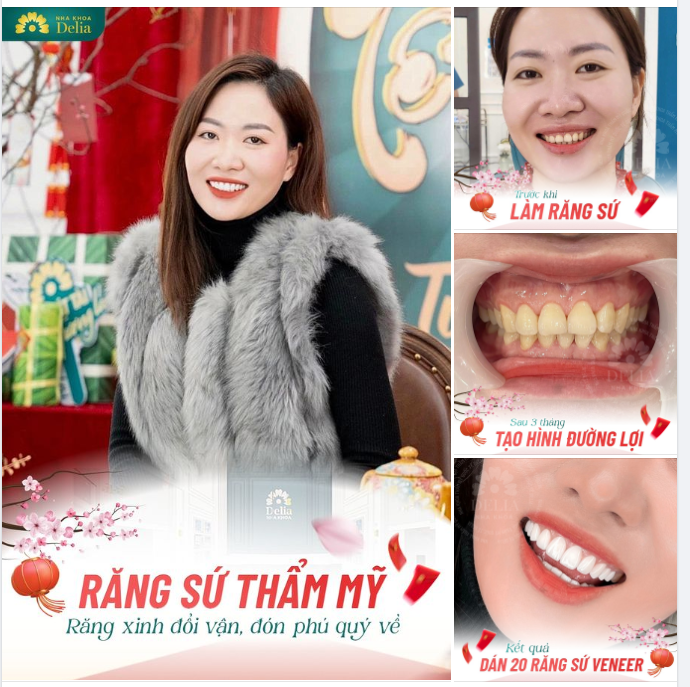 COMBO TẠO HÌNH VIỀN LỢI + DÁN VENEER 20 RĂNG SỨ >> RĂNG XINH ĐỔI VẬN - ĐÓN LỘC PHÚ QUÝ