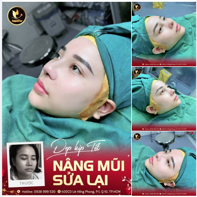 ĐẸP KỊP TẾT NÂNG MŨI SỬA LẠI